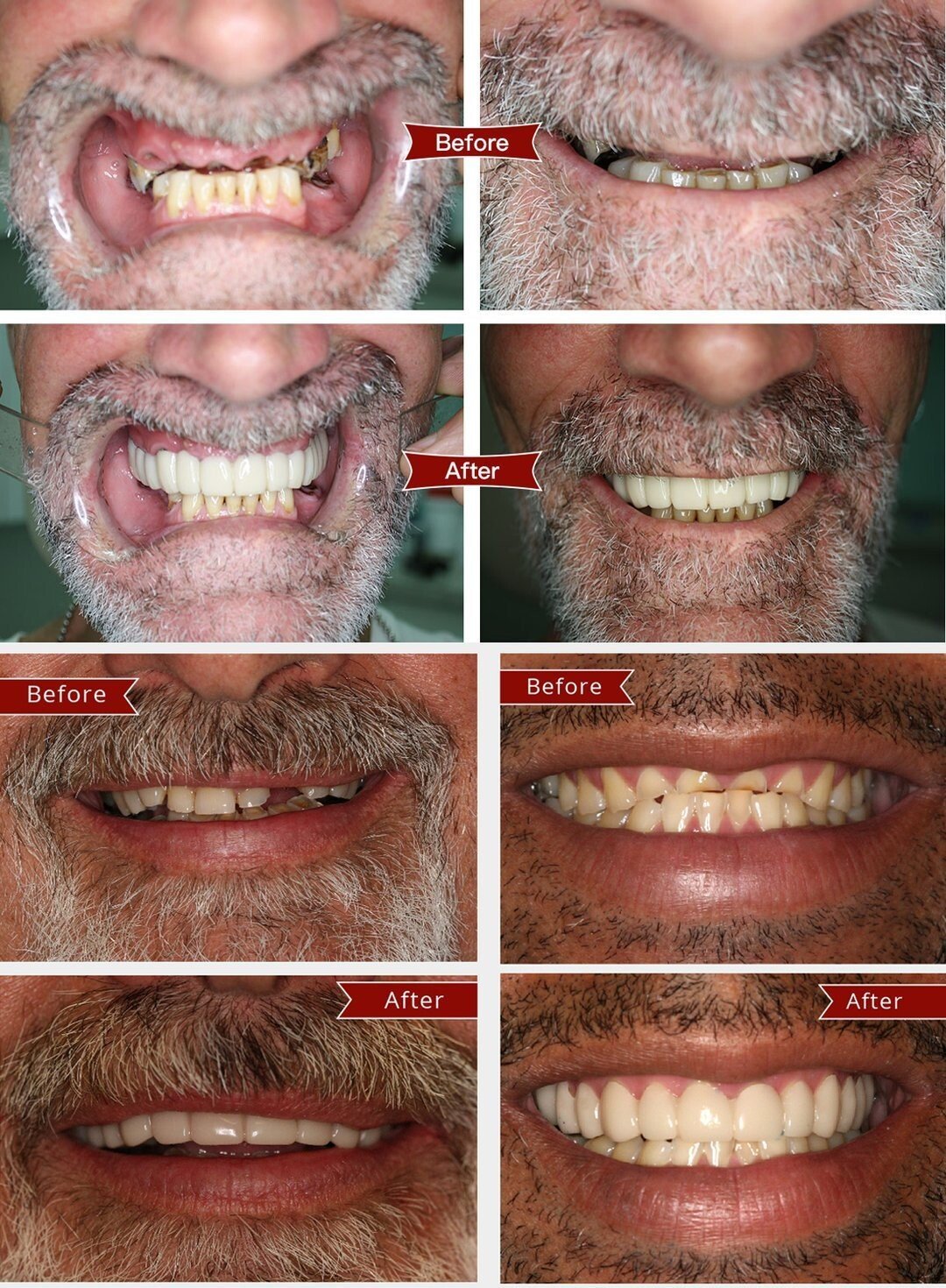 Latest👨⚕Adjustable Snap-On Dentures😁 (💥50% OFF) - 🔥HOT SALE🔥🎉
